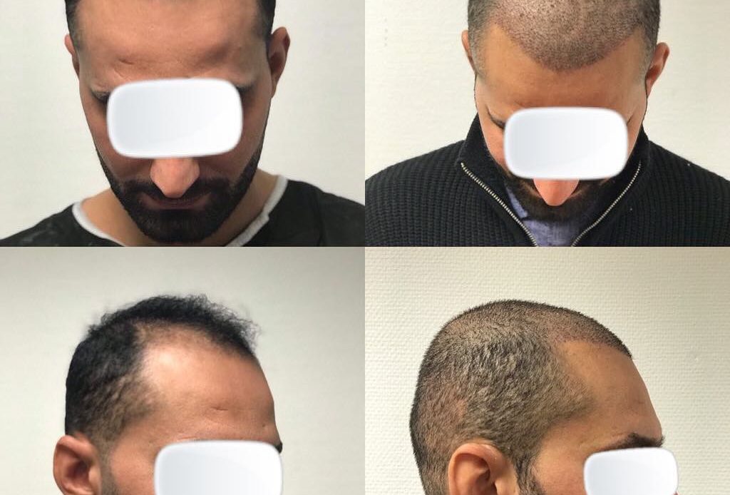 Hårtransplantation före efter