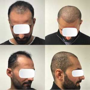 Hårtransplantation före efter