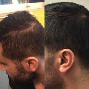 Hårtransplantation