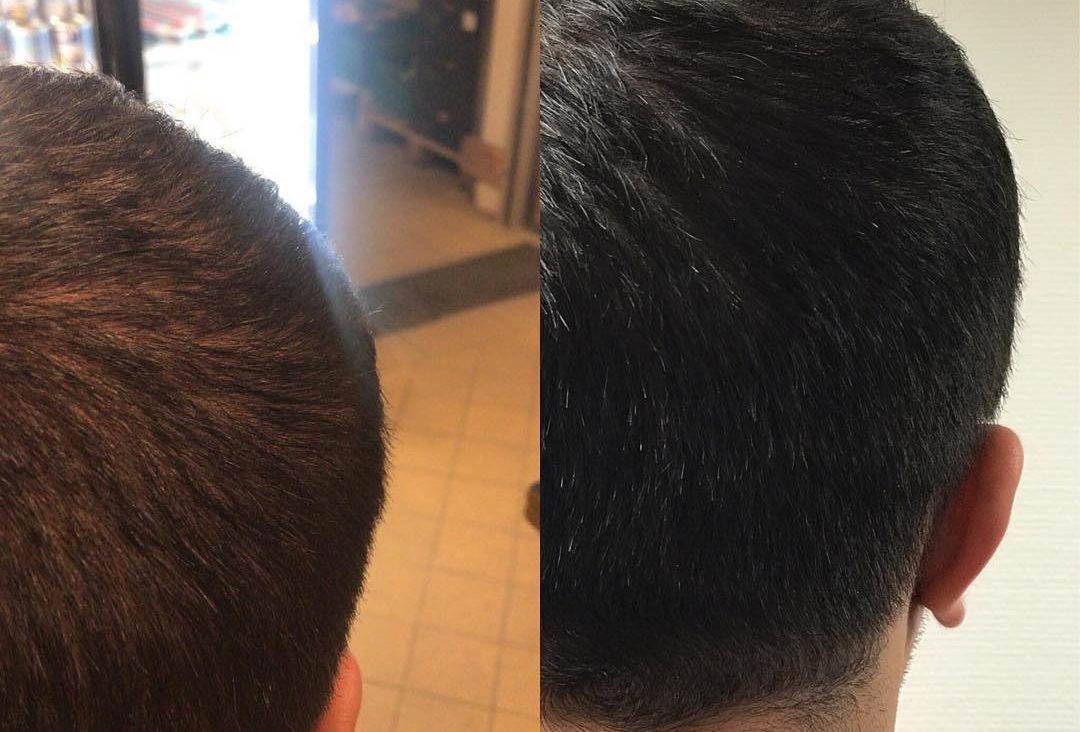 Hårtransplantation Sverige