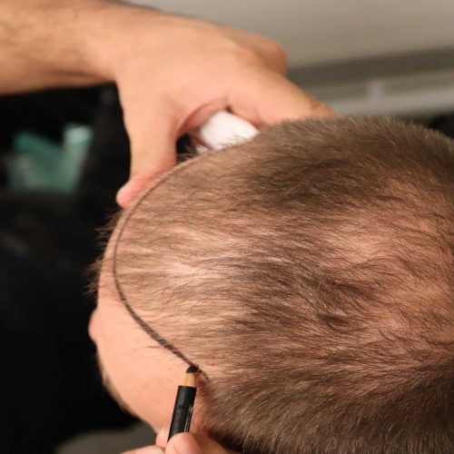 85 Kliniken Hårtransplantation