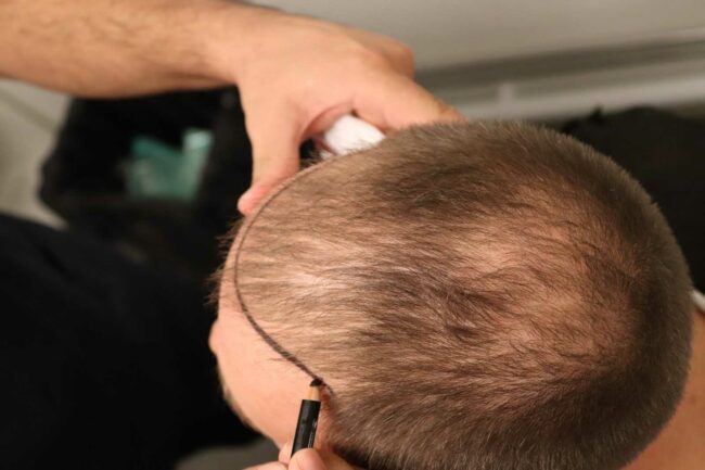 IMG_0208 85 Kliniken Hårtransplantation