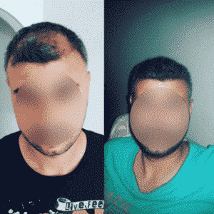 Före efter hårtransplantation