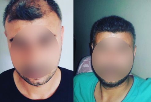 Före efter hårtransplantation