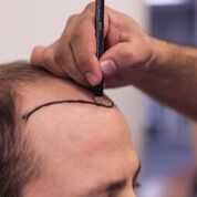 85 kliniken hårtransplantation sverige