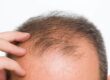 håravfall män