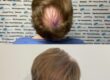 hårtransplantation före efter