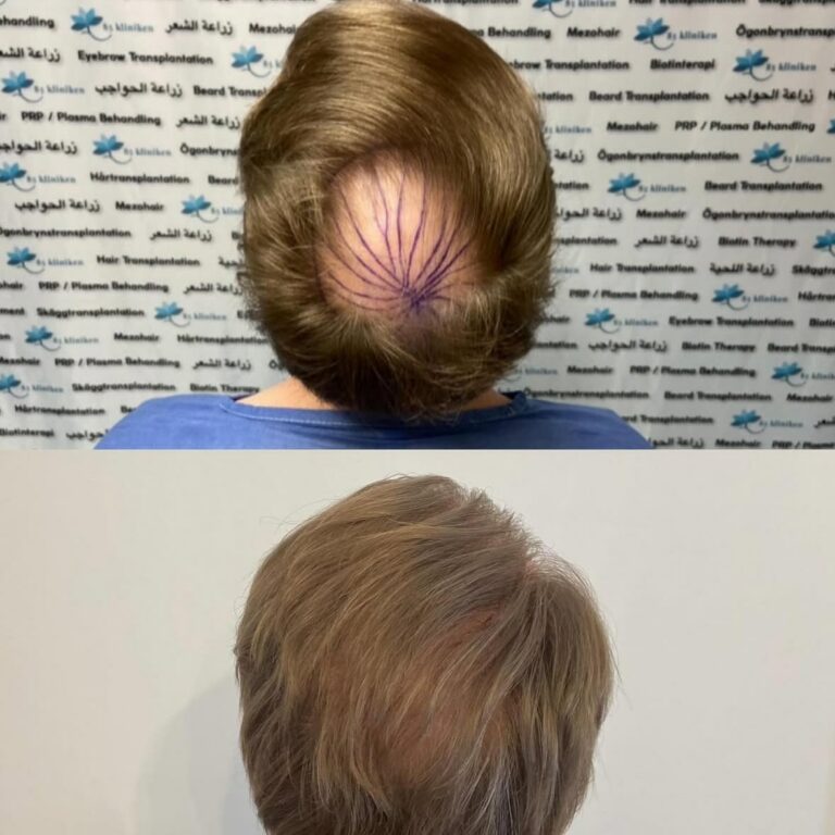 hårtransplantation före efter