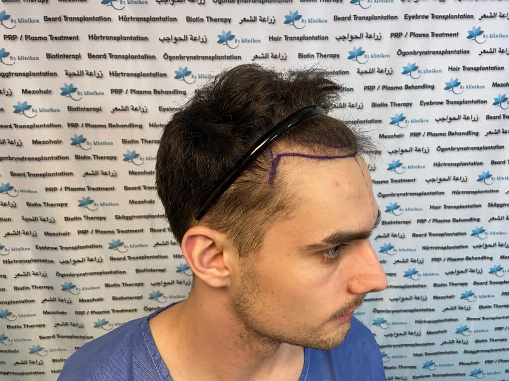 hårtransplantation kundresa