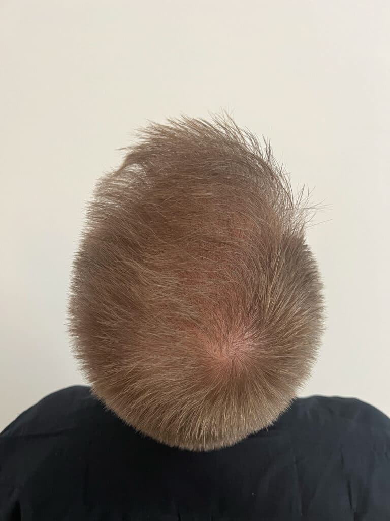 hårtransplantation resultat