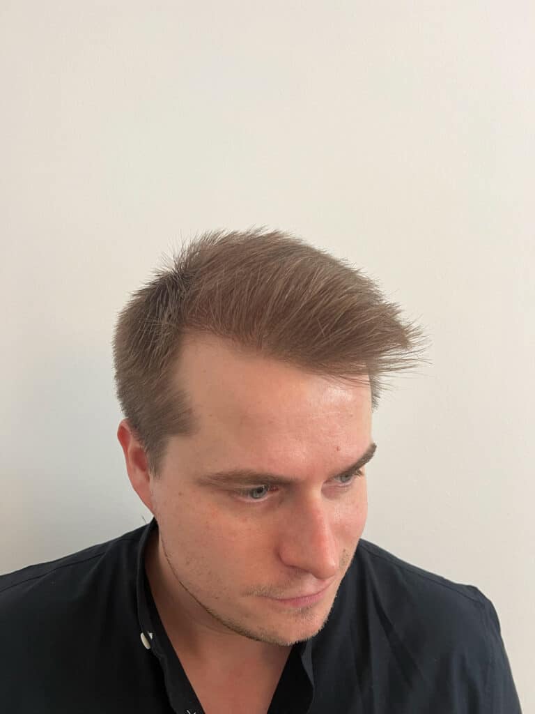 resultat av hårtransplantation