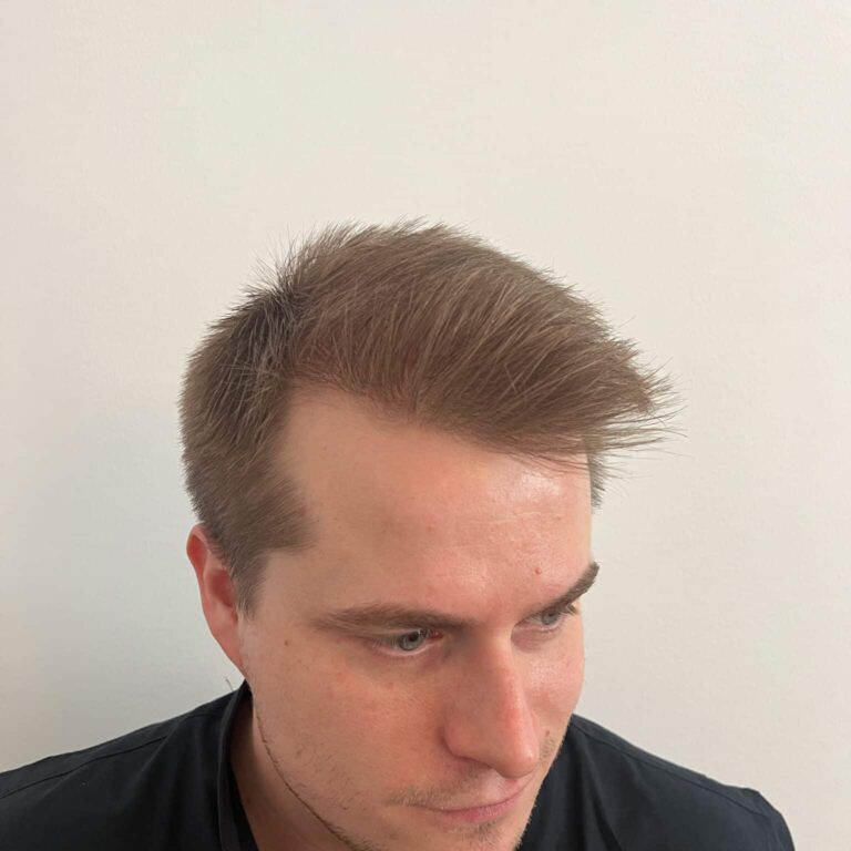 resultat av hårtransplantation