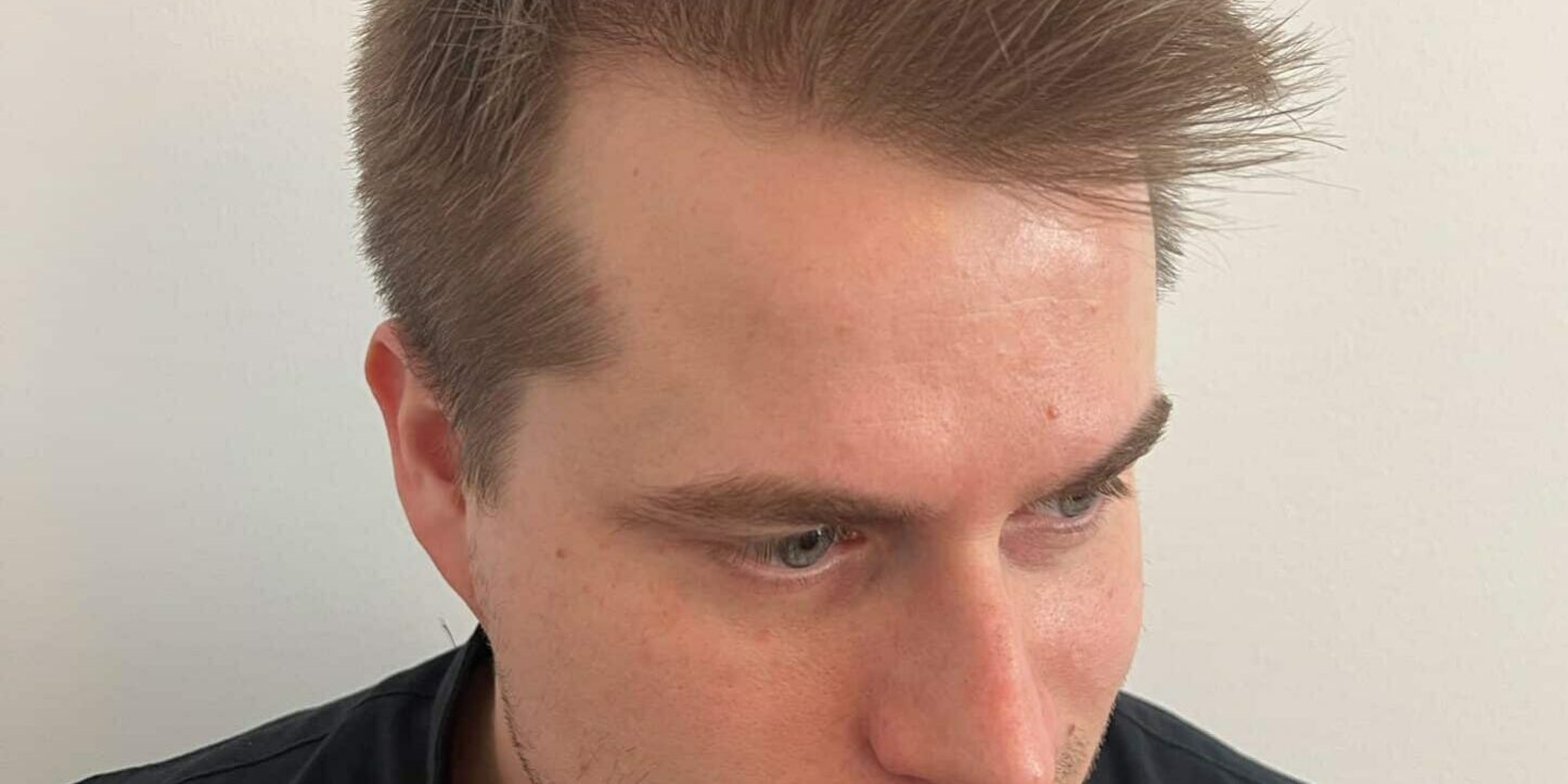 Resultat_efter_haroperation resultat av hårtransplantation