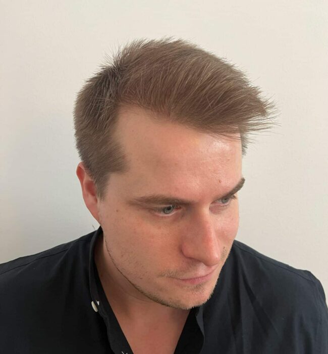 resultat av hårtransplantation