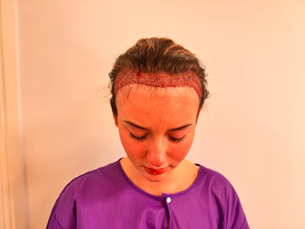 hårtransplantation kvinna