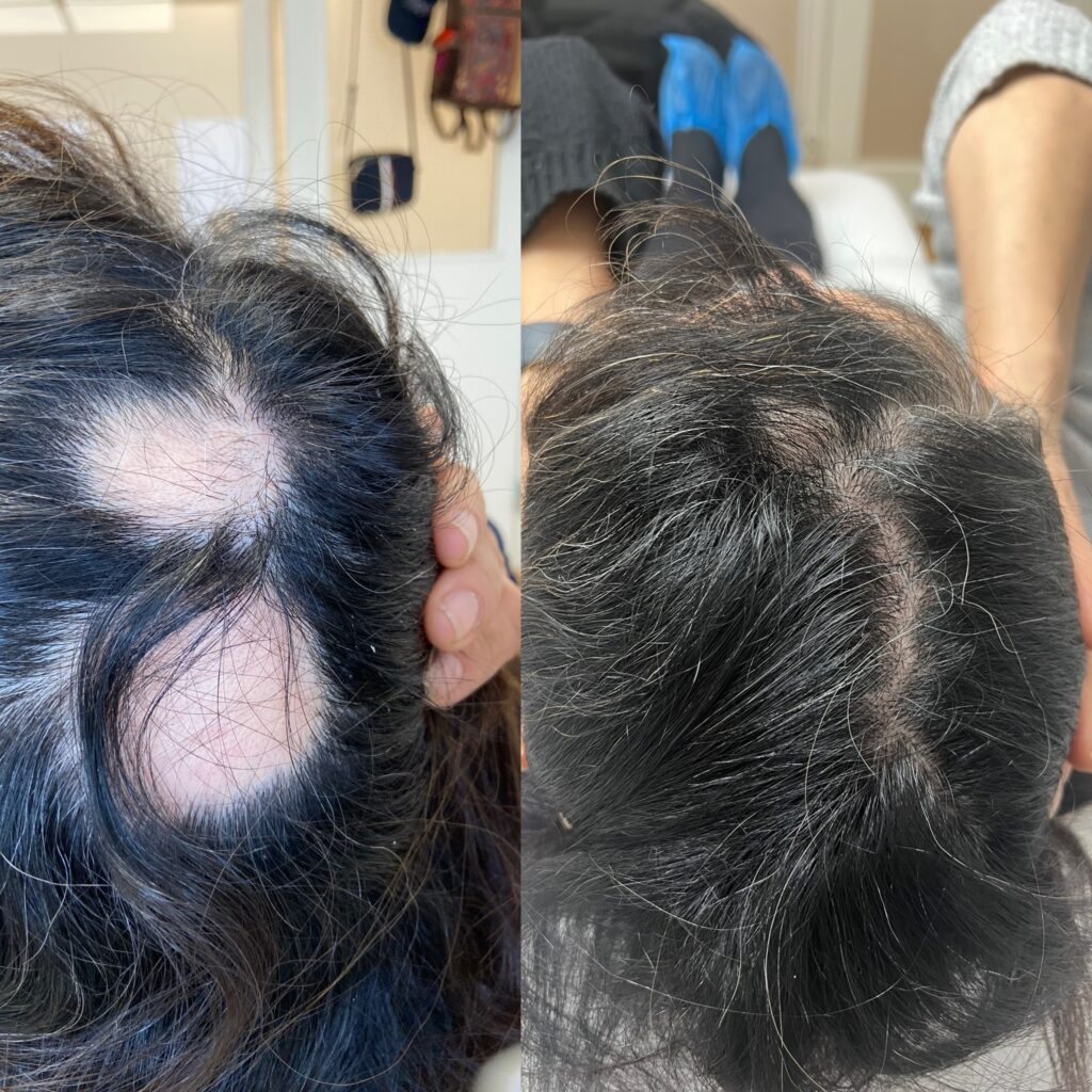 Alopecia Areata och PRP-behandling