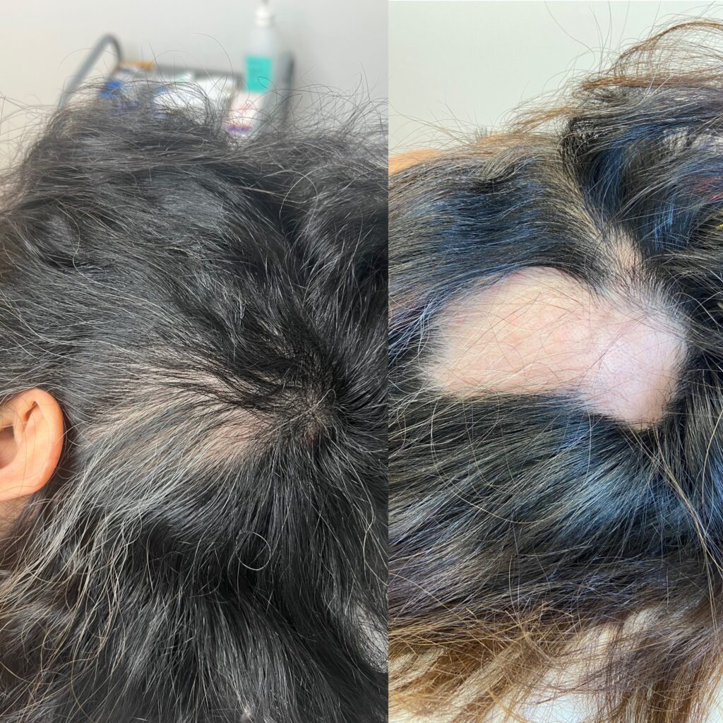 PRP behandling mot alopecia Areata