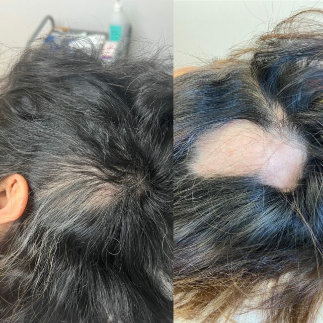 Resultat-av-prp-mot-alopecia PRP behandling mot alopecia Areata