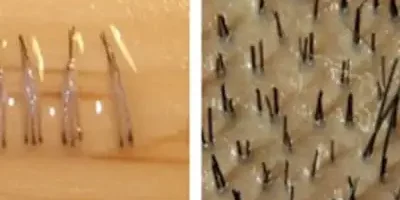 hår-grafts-hårsäckar hårtransplantation antal grafts