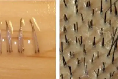 hårtransplantation antal grafts