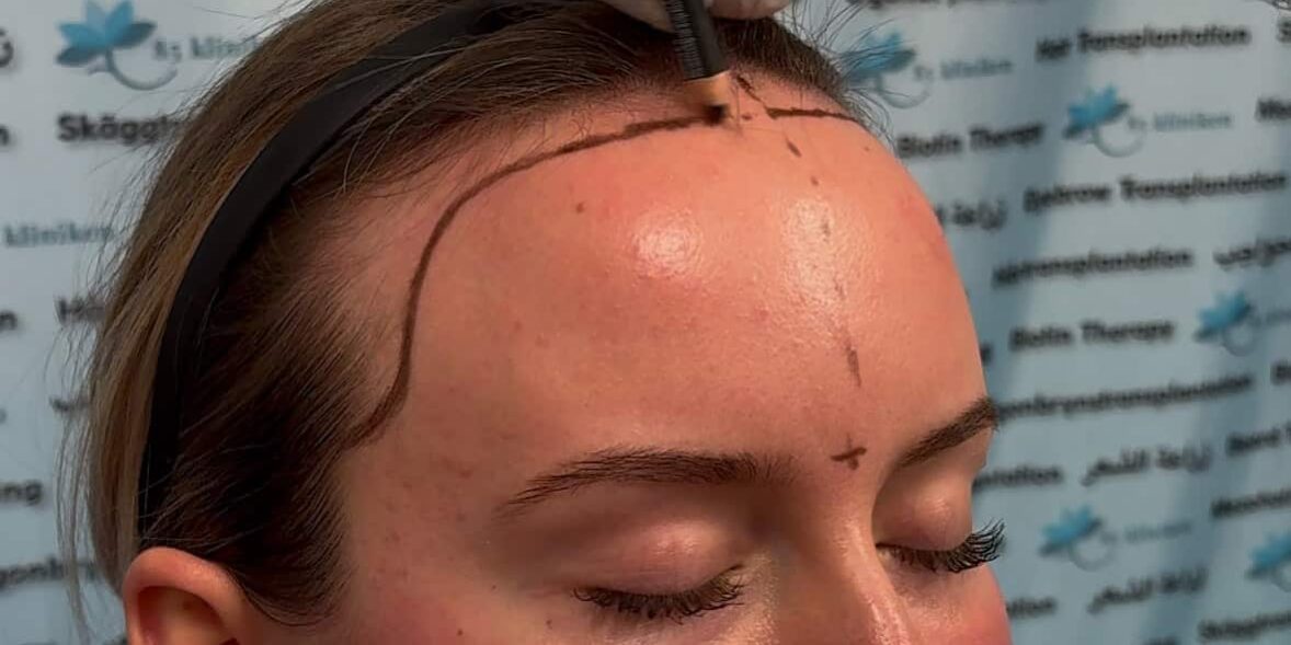 hartransplantion-kvinnor hårtransplantation kvinnor