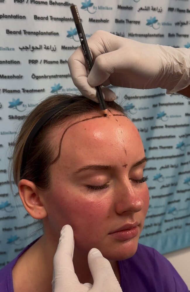 hårtransplantation kvinnor