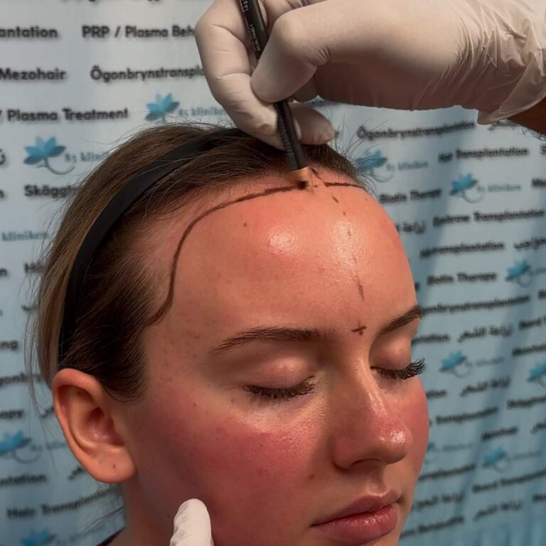 hårtransplantation kvinnor