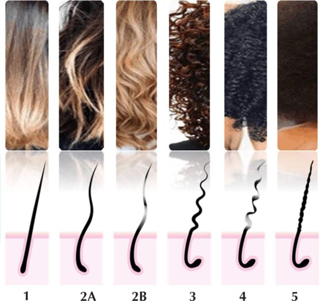 afro-hårsäckar hårtransplantation afrohår