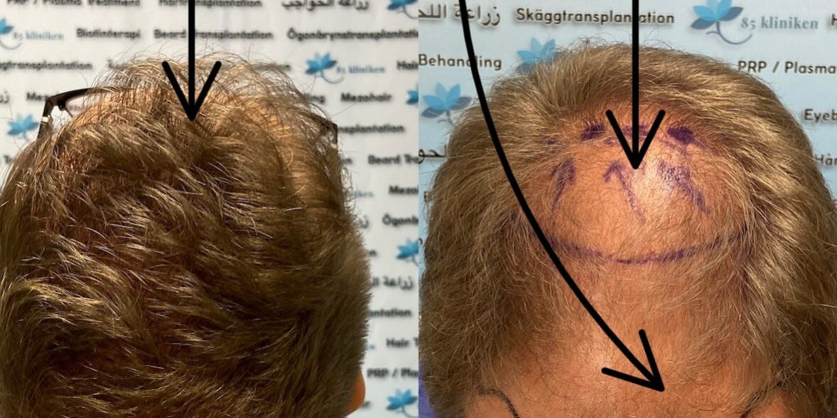 Hur många hårsäckar kan plockas vid en hårtransplantation?