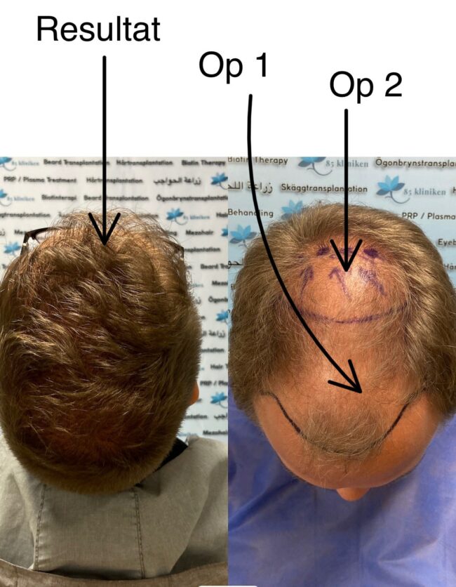 resultat-av-2-operationer Hur många hårsäckar kan plockas vid en hårtransplantation?