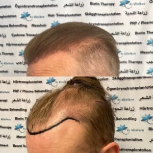 Hårtransplantation i två steg – Läs Martins berättelse hos 85kliniken