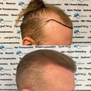 Hårtransplantation