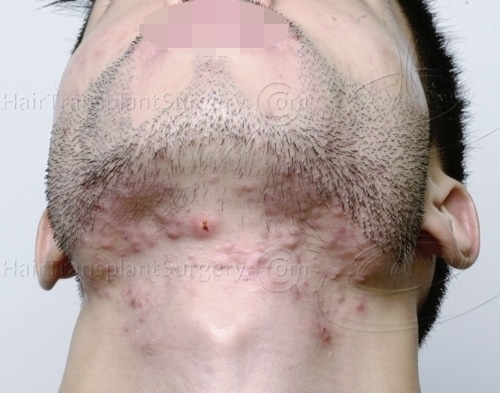 hårtransplantation från skägg