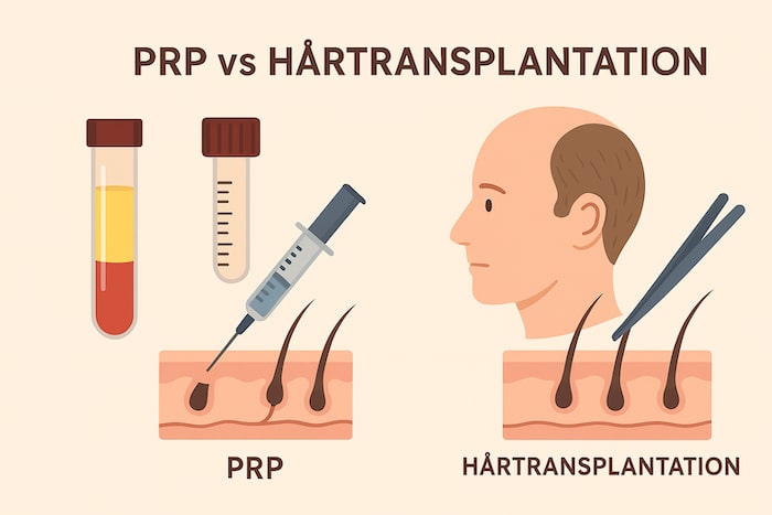 Kan PRP-behandling ersätta en hårtransplantation?