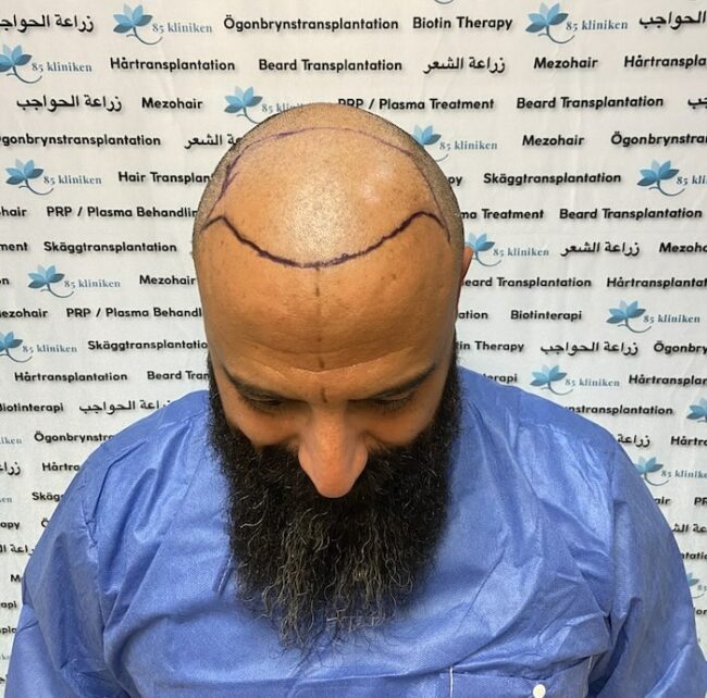 Amins hårtransplantation före
