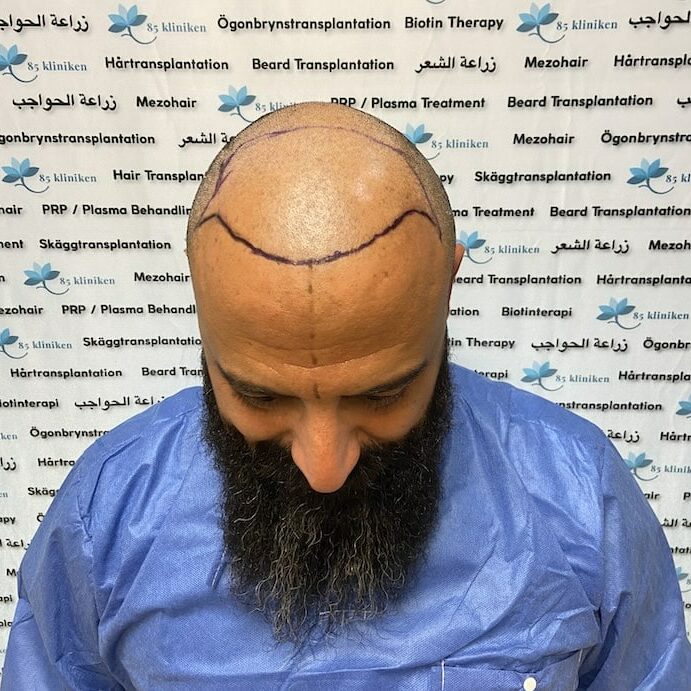 Amins hårtransplantation före