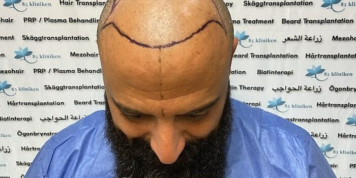 Amins hårtransplantation före