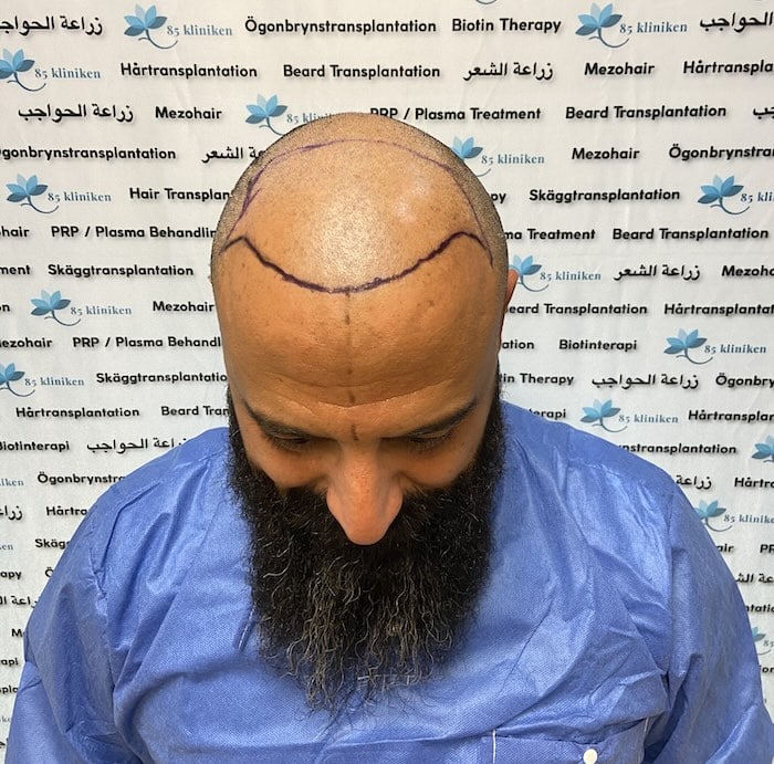 Amins hårtransplantation före