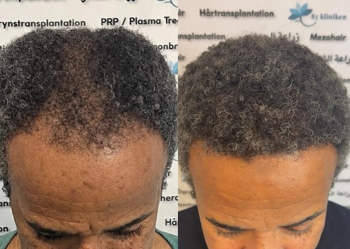 Hårtransplantation för afrohår – 48-årig patient återfick både håret och självförtroendet hos 85kliniken