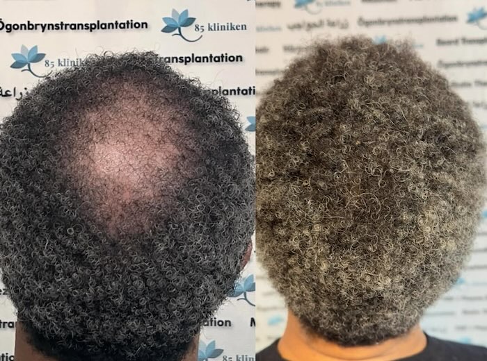 Hårtransplantation för afrohår – 48-årig patient återfick både håret och självförtroendet hos 85kliniken