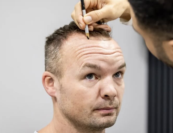 Expressen följde Alex hårtransplantation – en dokumentär om håravfall, hårtransplantation & vägen tillbaka till självförtroendet.