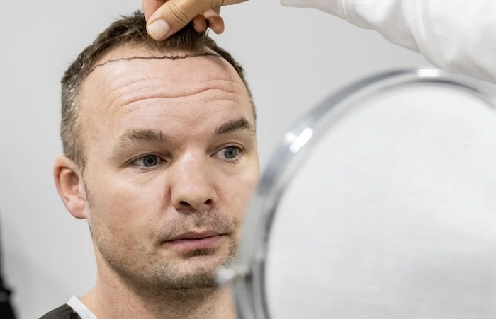Expressen följde Alex hårtransplantation – en dokumentär om håravfall, hårtransplantation & vägen tillbaka till självförtroendet.