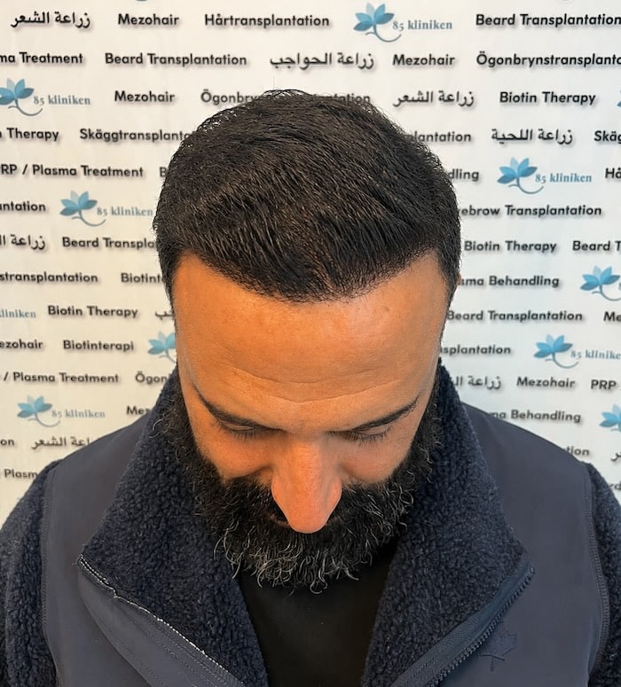 Amins hårtransplantation efter
