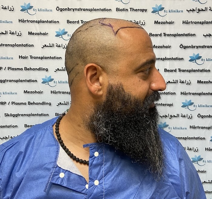 Amins hårtransplantation i Göteborg