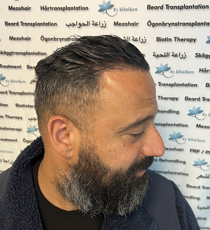 Amins hårtransplantation i Göteborg