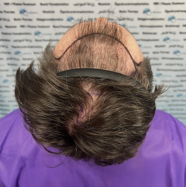 Chameks hårtransplantation hos 85kliniken