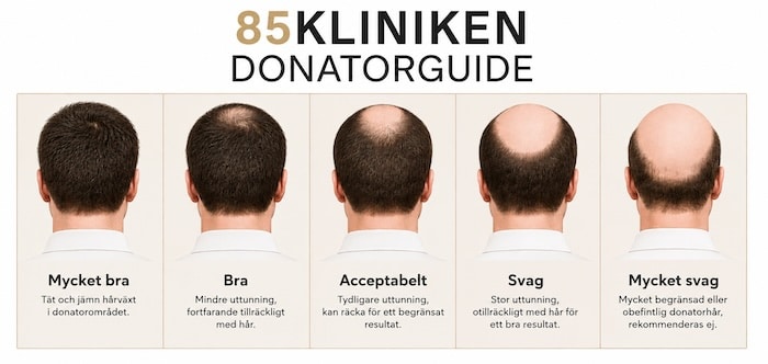 Svagt donatorområde vid hårtransplantation – den viktigaste faktorn för ett lyckat resultat
