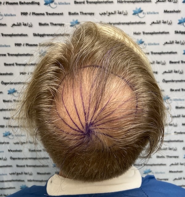 Roys hårtransplantation hos 85kliniken