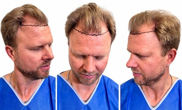 Roys hårtransplantation hos 85kliniken