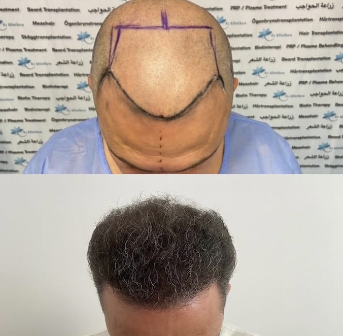 Patrik, 46 år – Så återfick han ett naturligt hårfäste med 4 000 hårsäckar på 85kliniken i Stockholm